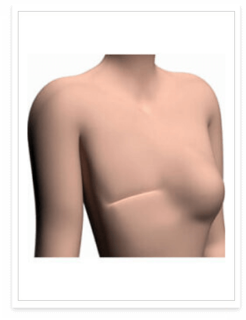 breast prosthesis fitting in delhi